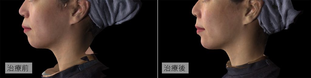 艾麗斯膠原蛋白新生材質注射在下巴處，建立骨架支撐