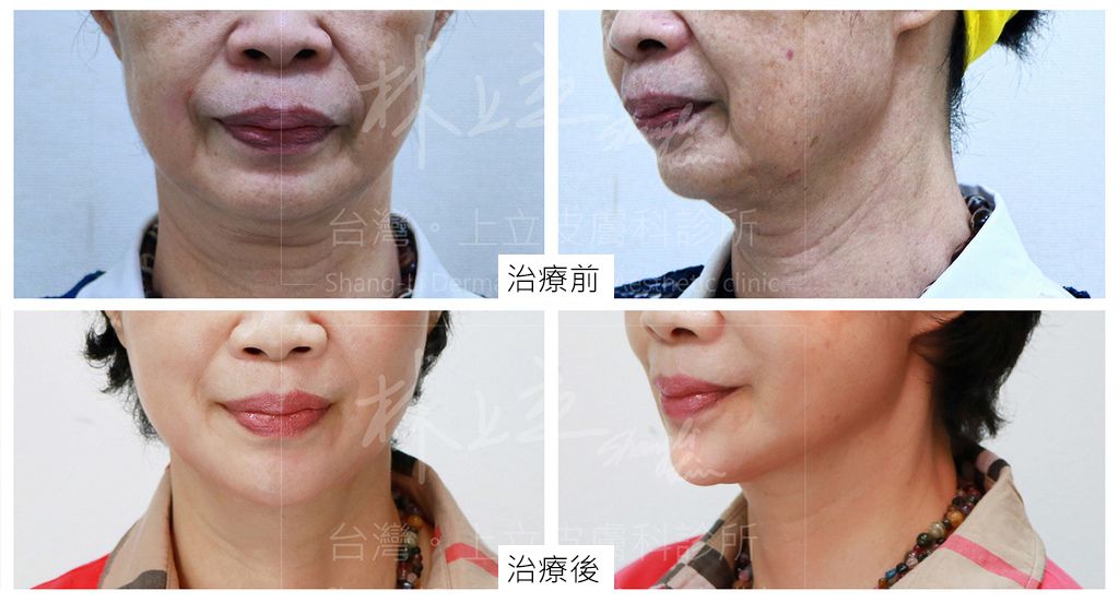 洢蓮絲重建臉部的骨架支撐，拉提臉部輪廓