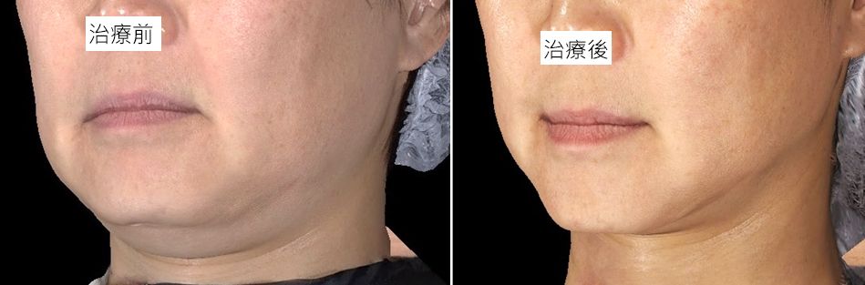 音波拉提利用聚焦超音波的能量，使筋膜組織收縮並刺激膠原蛋白新生