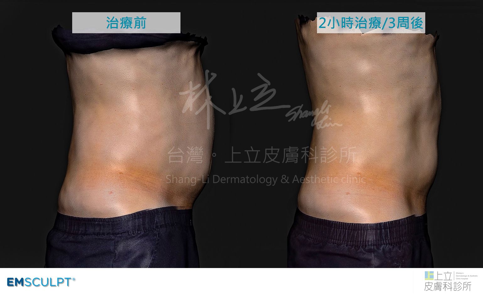 EMSCULPT肌動減脂可以同步減少皮下脂肪和內臟脂肪，為腹部雕塑帶來相當好的成果