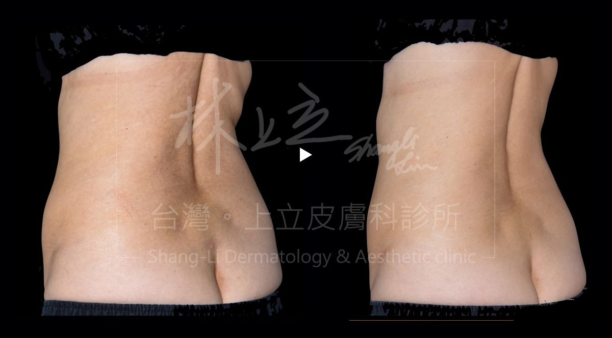 SculpSure可透過探頭排列組合的靈活調整來治療，雕塑出迷人的腰背曲線。