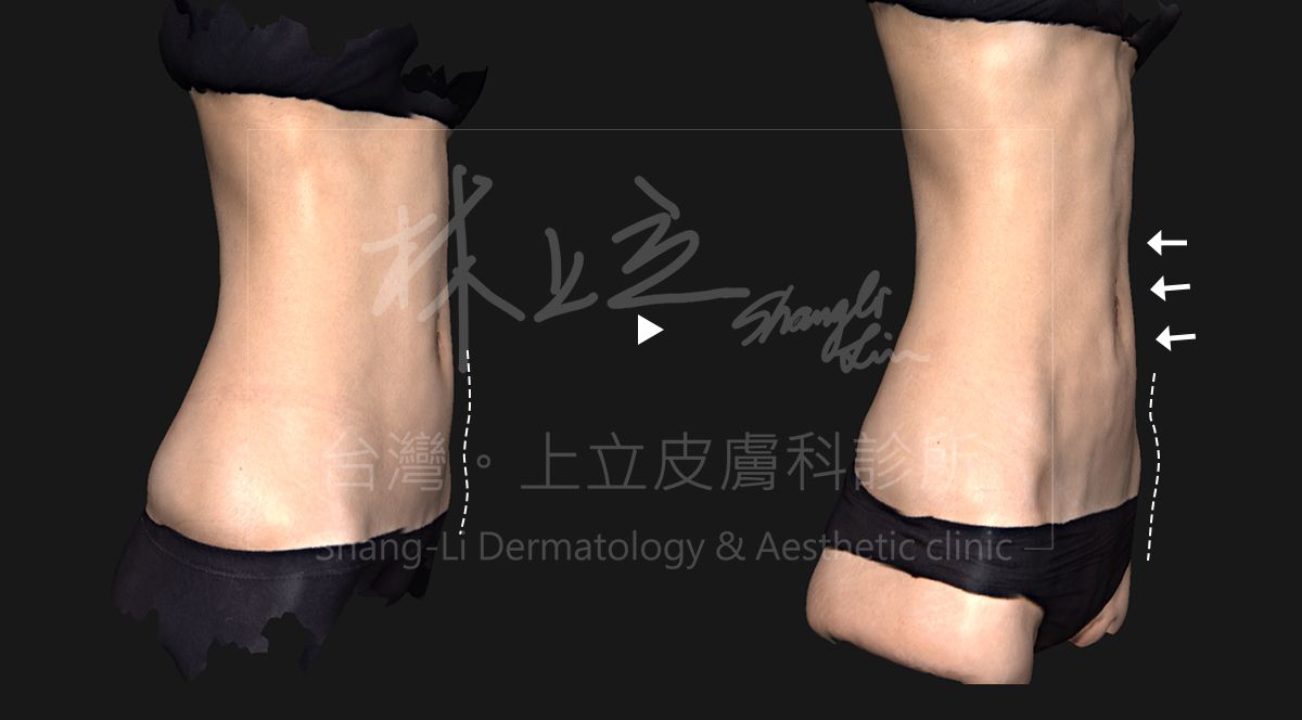 本身偏瘦、皮下脂肪較薄的族群，SculpSure 絲酷秀也能給予治療