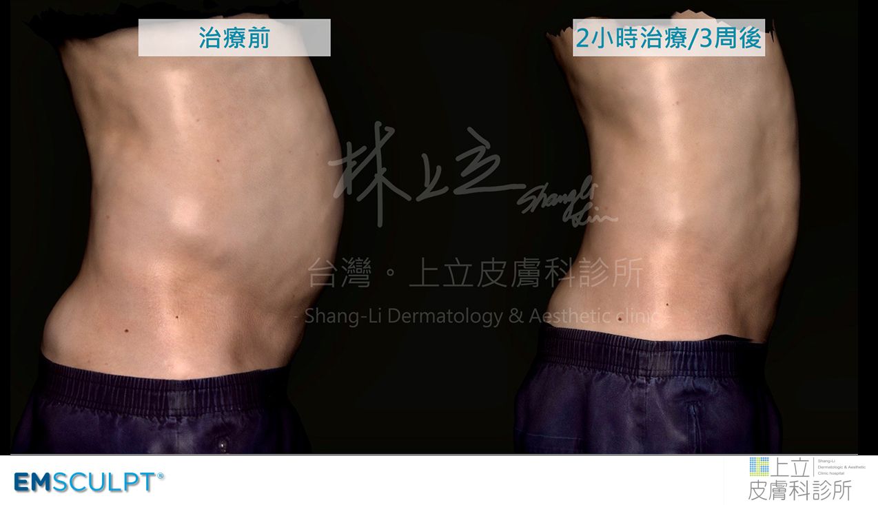 EMSCULPT肌動減脂的優勢就是可以同步減少皮下脂肪和內臟脂肪
