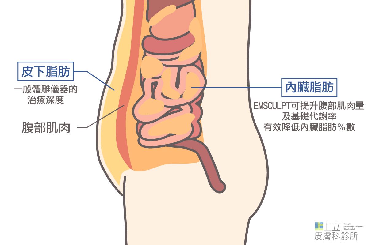 EMSCULPT肌動減脂（肌動翹臀）不只能減少皮下脂肪，也能有效降低內臟脂肪的問題。