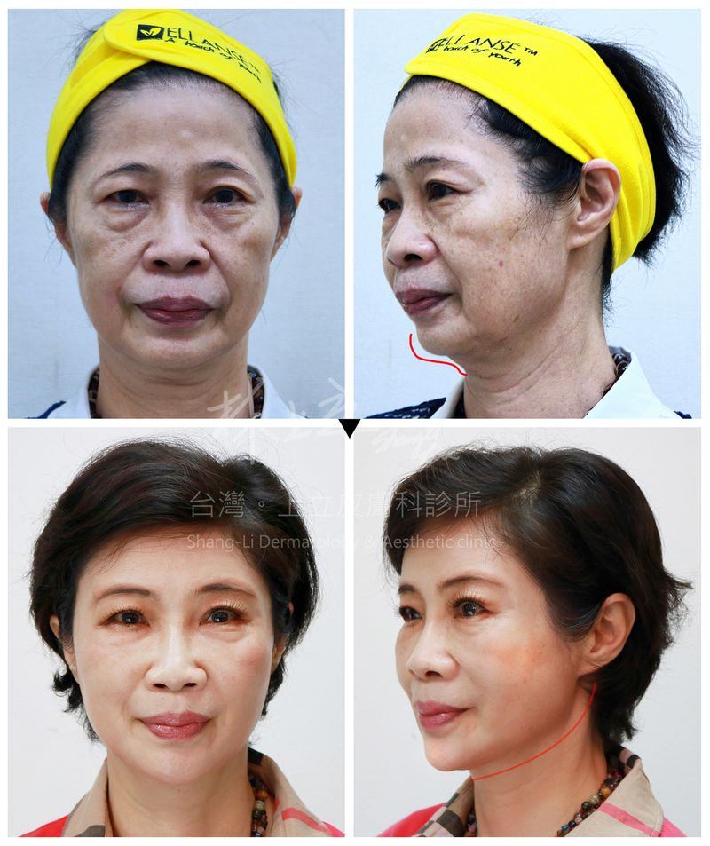 Ellans&eacute;洢蓮絲重建全臉的骨架支撐，改善了各種紋路(淚溝、法令紋、木偶紋)，雙下巴也因為支撐建立