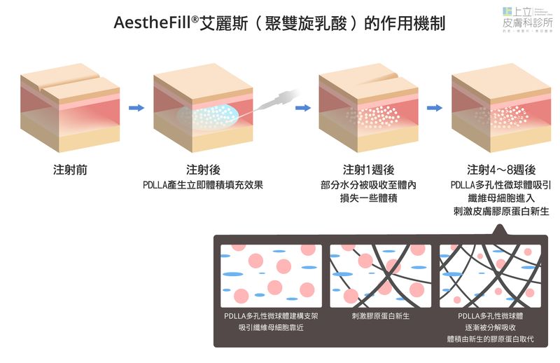 AestheFill艾麗斯的作用原理