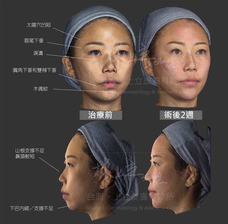 AestheFill艾麗斯整體規劃，同時重建下巴支撐，術後除了雙下巴改善，臉頰上提、嘴角下垂改善