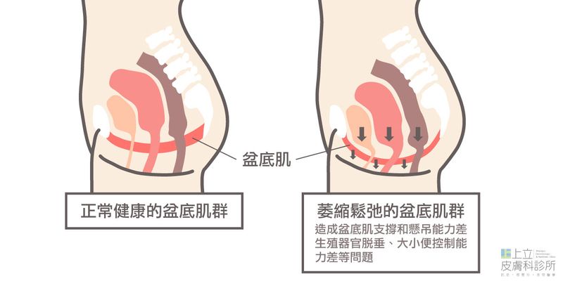 骨盆底鬆弛，造成漏尿、尿失禁、性交困難的問題。