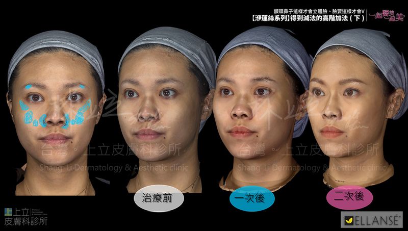 治療效果更加自然、精緻，林上立醫師將治療分為透過二次階段治療。
