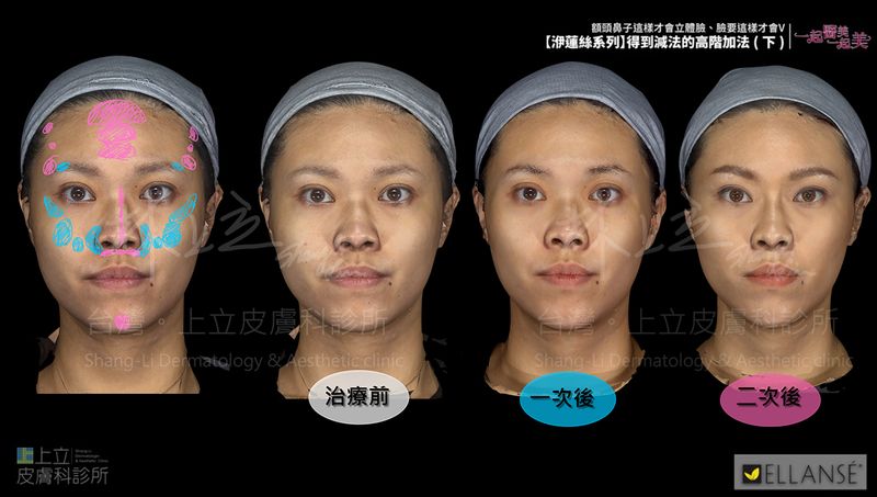 治療效果更加自然、精緻，林上立醫師將治療分為透過二次階段治療。