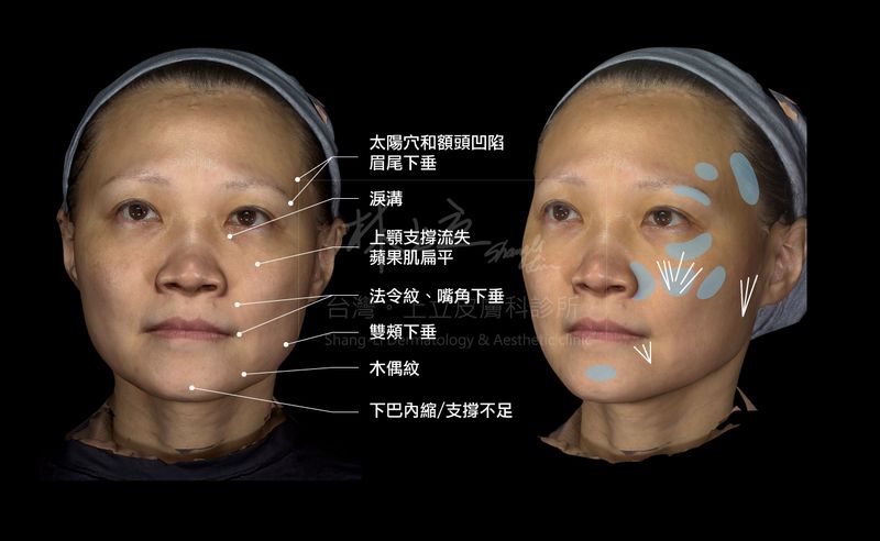 大範圍的洢蓮絲注射著重劑量的分配效果，可以看出術後效果精緻自然。