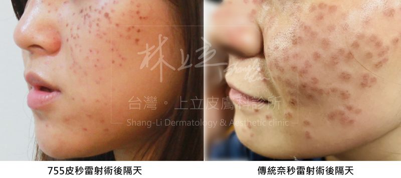 755皮秒雷射術後結痂輕薄，傳統奈秒雷射結痂厚實、大片的結痂