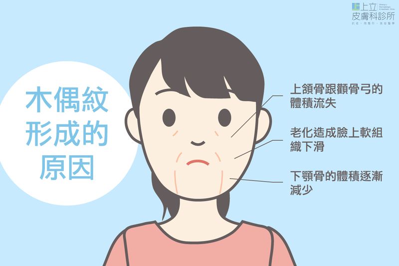 木偶紋形成的原因