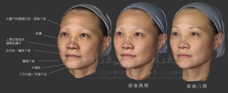 用艾麗斯治療後，八周內得到顯著的改善。