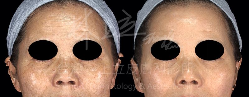 PicoSure755蜂巢皮秒雷射術後不只眼下、鼻子上的斑點減少許多