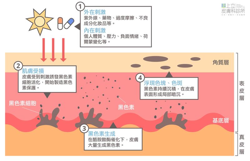 斑點產生原因和形成機制和黑色素有關