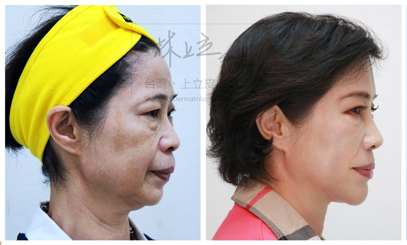 洢蓮絲治療後，輪廓線都明顯許多，連同法令紋等深層皺紋也有明顯的改善。