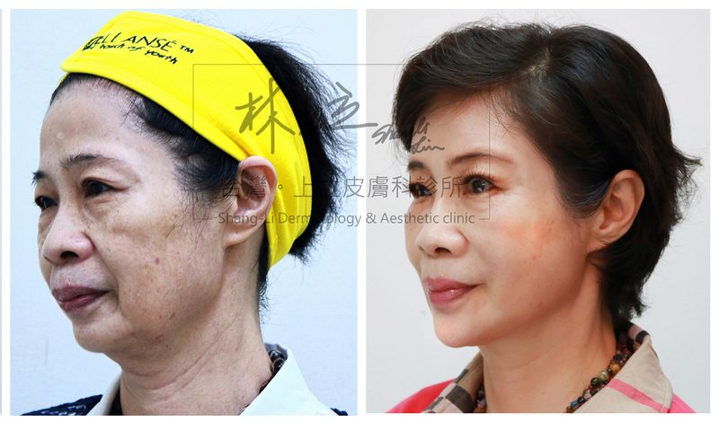 洢蓮絲治療後，輪廓線都明顯許多，連同法令紋等深層皺紋也有明顯的改善。