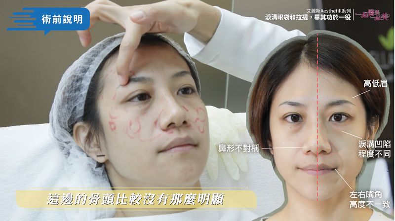 Ada利用AestheFill艾麗斯（聚雙旋乳酸，俗稱精靈針）來治療法令紋、蘋果肌