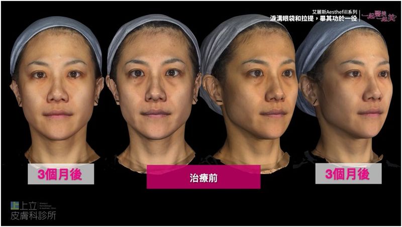 Ada在注射AestheFill艾麗斯重建全臉體積支撐之後，淚溝消失了，臉部輪廓也恢復飽滿度，讓整個人看起來年輕、有精神許多。