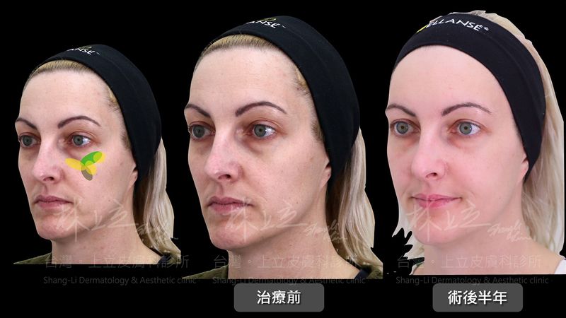 林上立醫師施打洢蓮絲增加了兩頰蘋果肌的飽滿度，藉此讓臉部輪廓線條柔和、圓滑