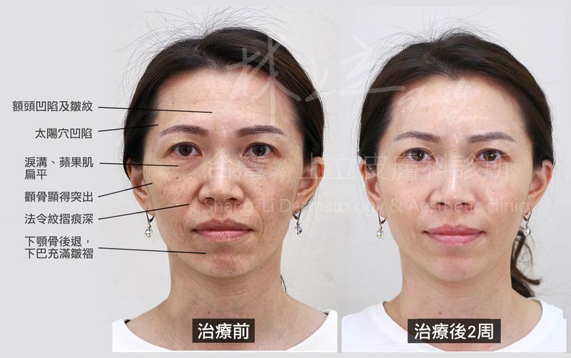 洢蓮絲治療之後，不只整個輪廓線條變柔和，臉部比例呈現年輕的倒三角形，