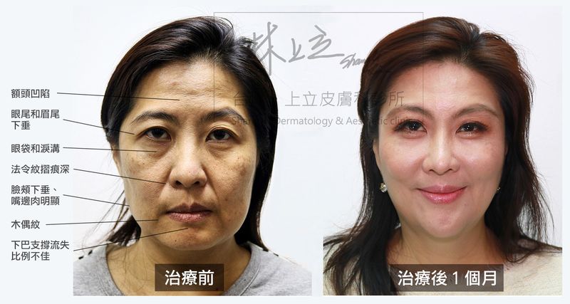 這些問題也都不是做完法令紋墊片就可以解決的，臉的下垂不會改善，法令紋摺痕也不能消除，只有鼻子周圍的陰影會改善一部份而已。