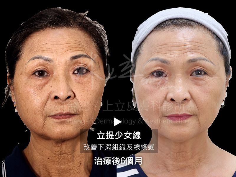 立提少女線術後6個月改善下滑組織及線條感