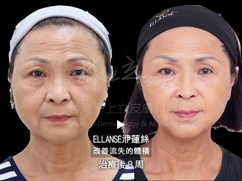 洢蓮絲數後8周改善流失的體積