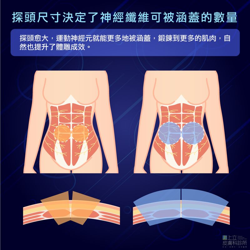 治療減脂的探頭尺寸影響了神經纖維涵蓋數量