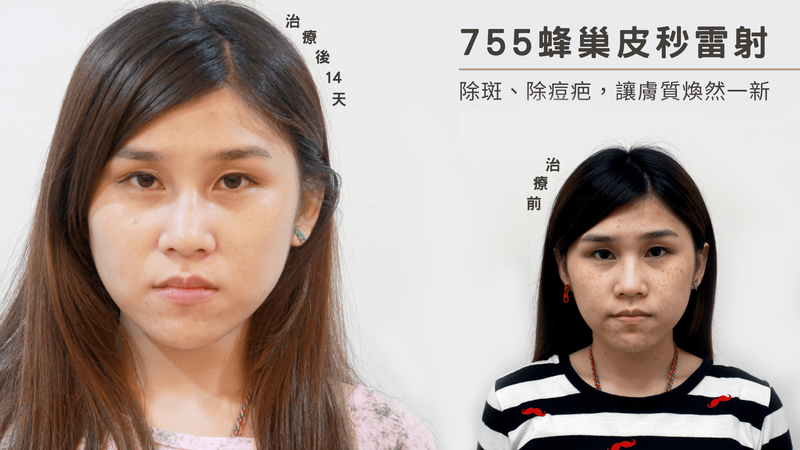 755蜂巢皮秒雷射快速改善斑點