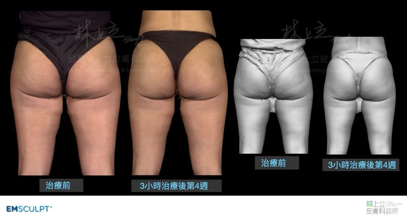 EMSCULPT肌動減脂的鍛鍊，顯得更翹、渾圓，線條不再鬆弛、凹凸不平，微笑線也笑得更開心了。