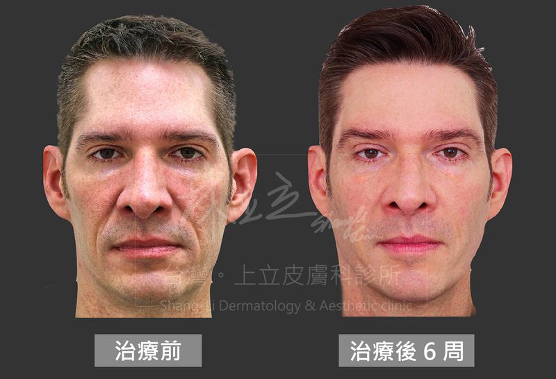 林上立醫師曾治療過的西方人個案，解決法令紋，不用再按摩