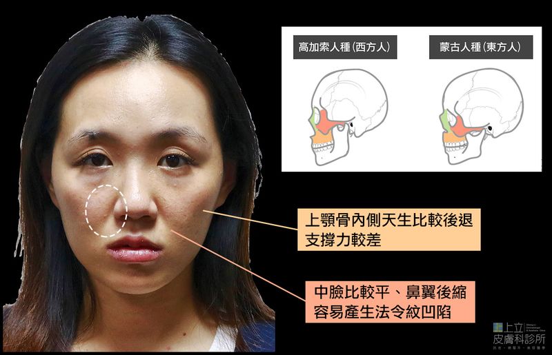 亞洲人的法令紋則多半來自於凹陷及皺折，按摩也解決不了