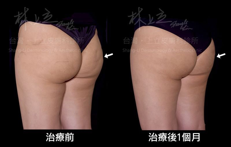 SculpSure絲酷秀治療之後，脂肪細胞減少，不只臀形變翹，就連橘皮組織也跟著消失