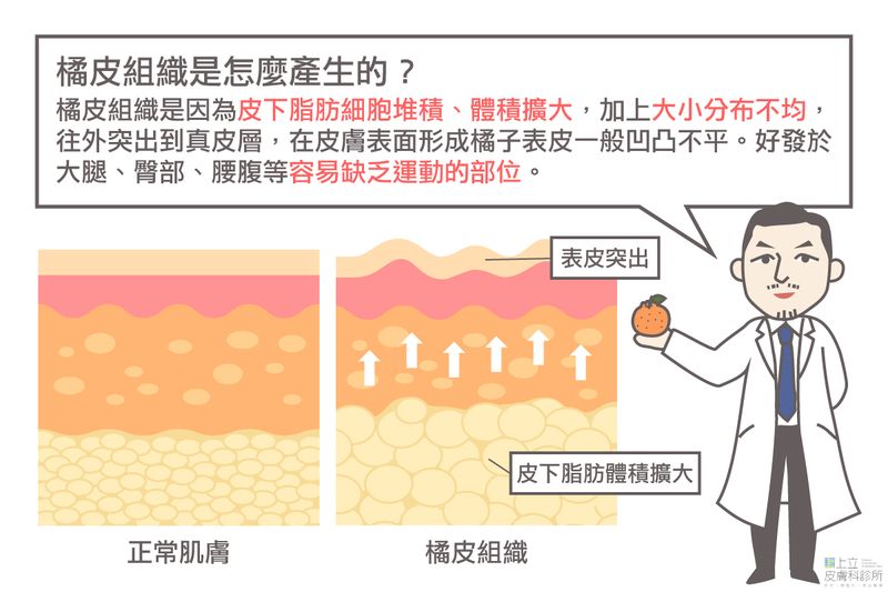 橘皮組織是怎麼產生的？