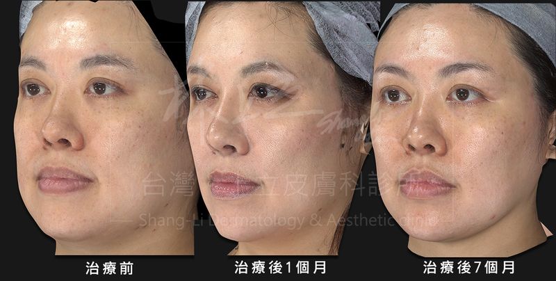 晶亮瓷治療後７個月的改善效果已明顯下降
