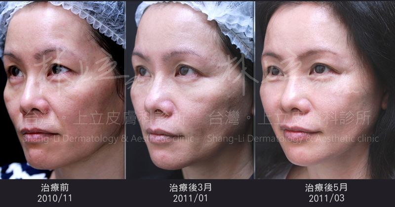 舒顏萃治療後５個月才能看見比較明顯的改善效果