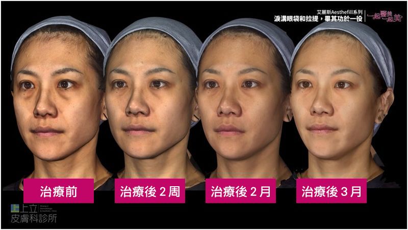 艾麗斯治療後２周，淚溝已有明顯改善