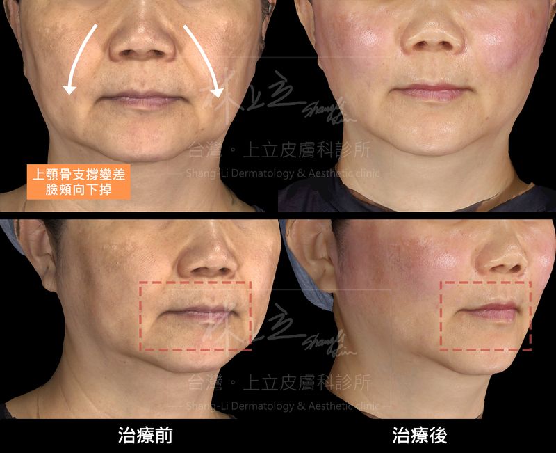 人中的立體度變好、嘴形變翹，嘴角木偶紋也有相對改善。