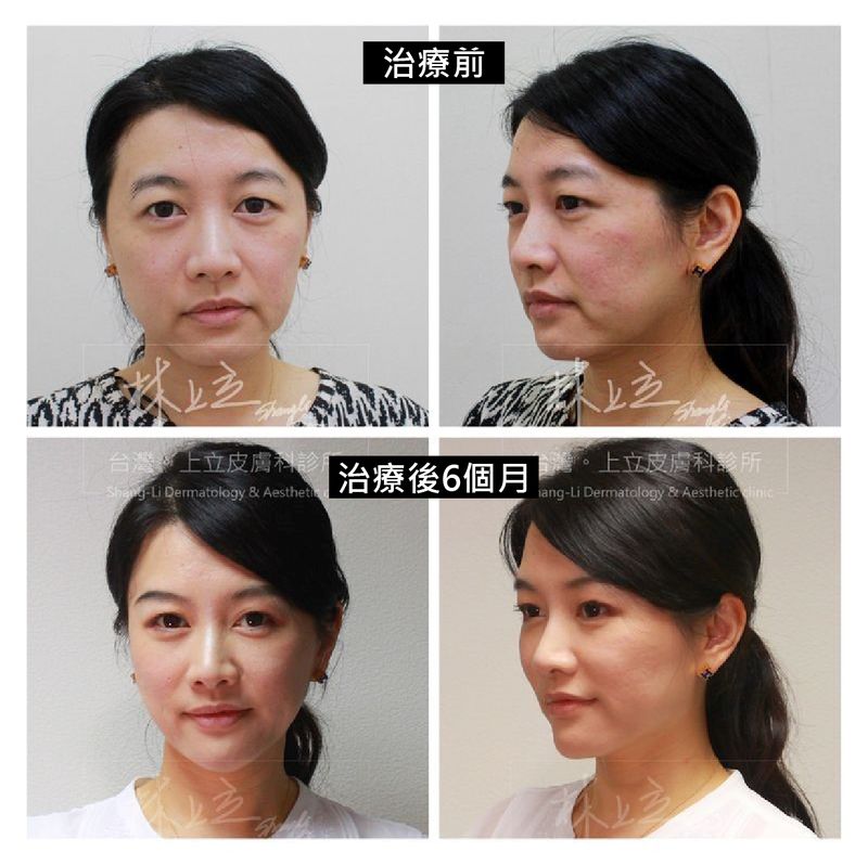 改善木偶紋、嘴邊肉都有顯著成效，也讓臉頰緊實，下顎線重現俐落感