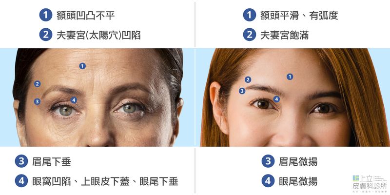 額頭骨架會流失，額頭的脂肪墊深層脂肪體積也會逐漸減少
