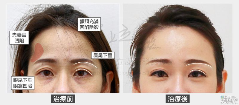 注射ELLANSE洢蓮絲治療之後，不只額頭恢復年輕飽滿度，並且改善細紋
