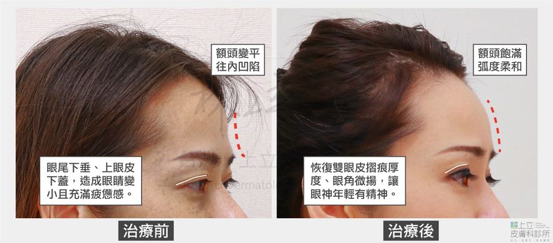 注射ELLANSE洢蓮絲治療之後，不只額頭恢復年輕飽滿度，並且改善細紋