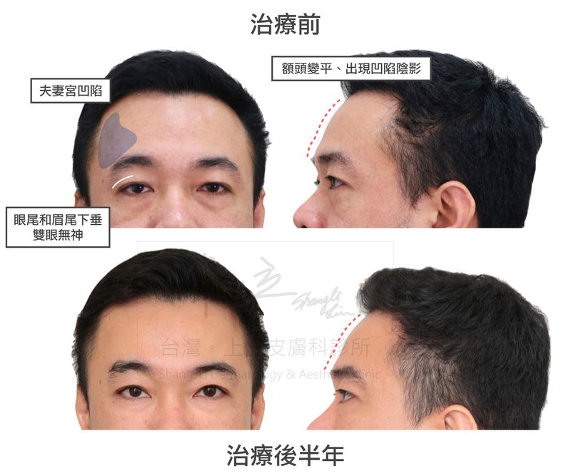 ELLANSE洢蓮絲增加額頭體積支撐，卻沒有將額頭打的過度飽滿，並重建眼眶骨的支撐，改善淚溝