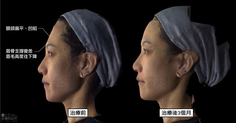 利用艾麗斯去增加額頭的深層脂肪和骨架體積，也針對顳部、眉骨等部位重建骨架支撐，改善凹陷