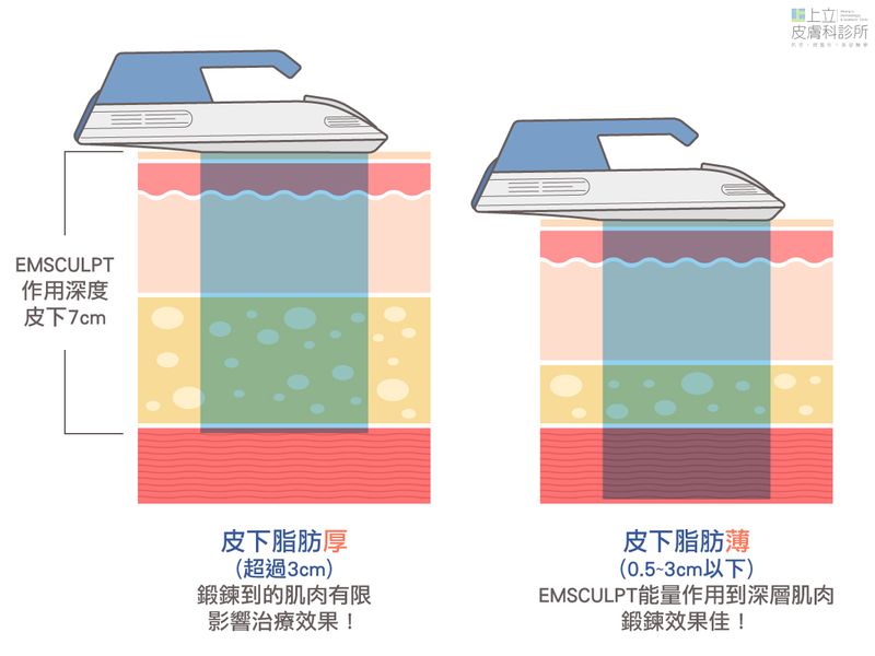 EMSCULPT肌動減脂的作用深度約為皮下7公分，假如皮下脂肪太厚，將影響治療效果變差。