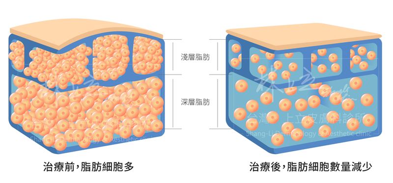 治療後脂肪細胞數量減少