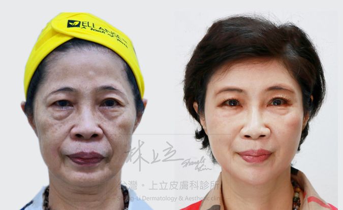 治療木偶紋時，不能只是去填補下巴，應該要同步把中臉的問題一起解決了，木偶紋自然也會跟著改善許多，甚至在視覺上還有拉長下巴比例的效果。