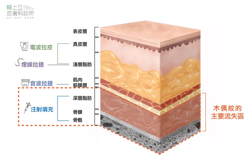 不論是電音波或埋線的作用層次都比較淺，對於木偶紋的改善幫助不大。